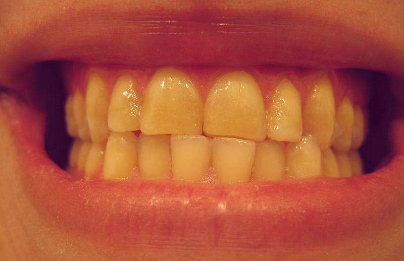 Illustration for article titled Are You a Nighttime Tooth Grinder? Here's How To Tell—And What to Do About It